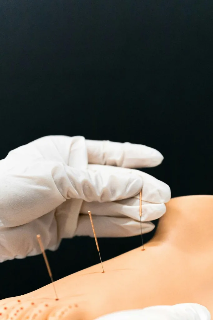 Acupuncture needles placed during a treatment session
